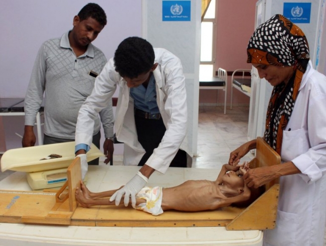 Yemen'de açlık, iç savaşı gölgede bıraktı